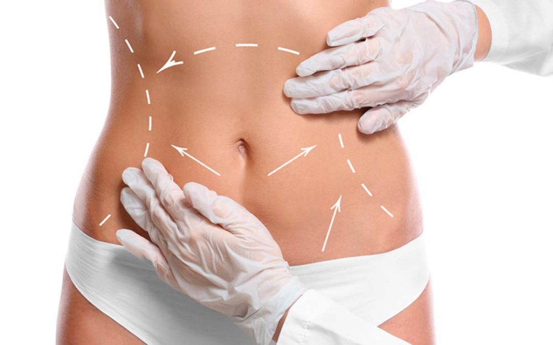 липосакция в Москве doctorvis.ru